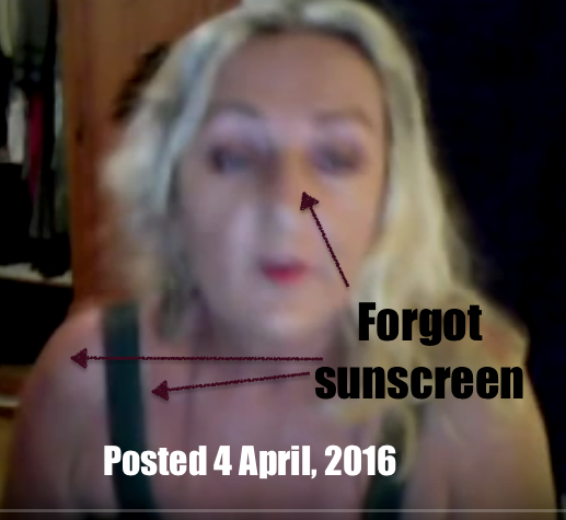 Angie-sunburnt 2016-04-07